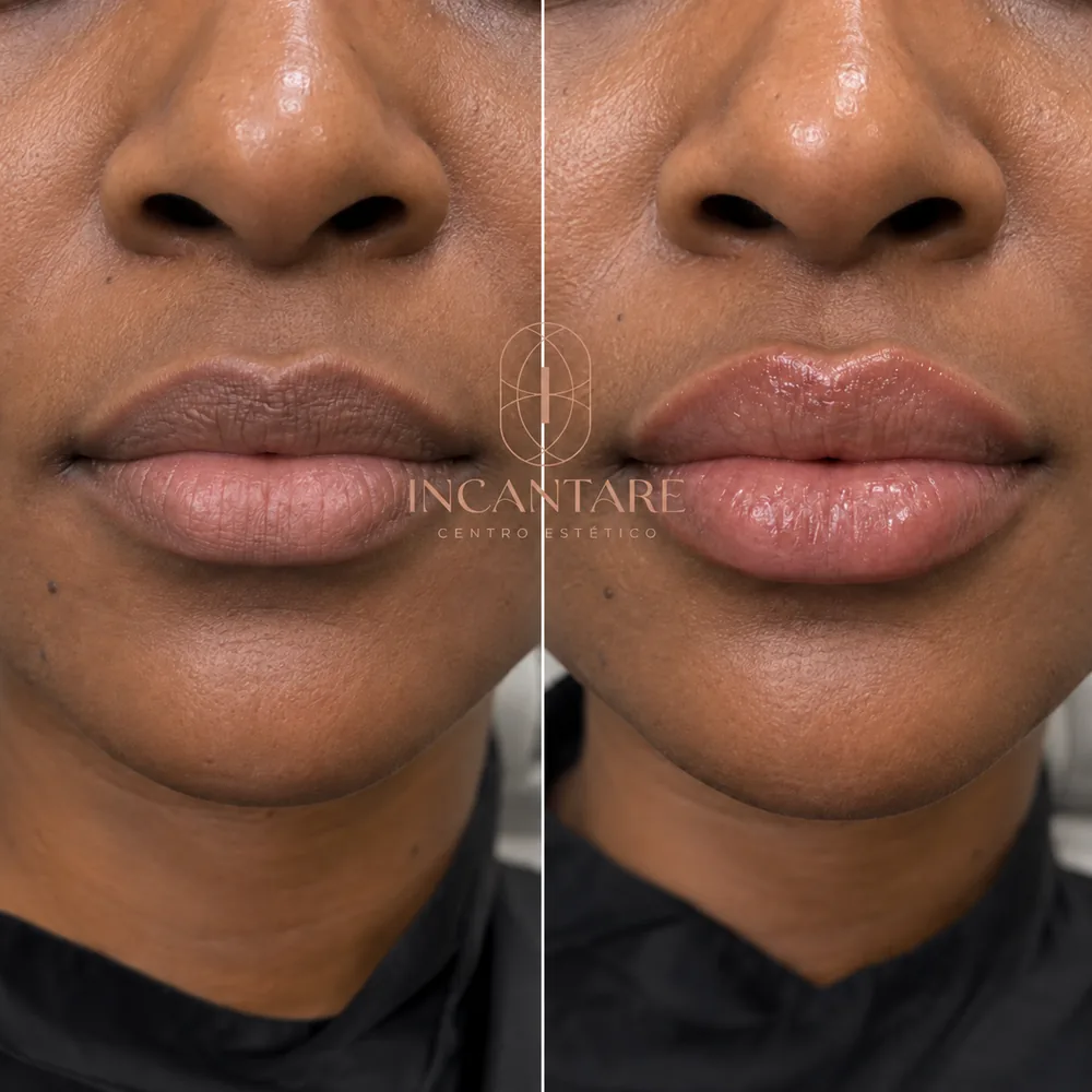 Antes e depois do preenchimento labial — exemplo 2